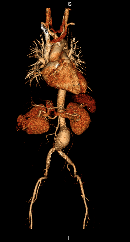 3D ANGIO ABDOMINAL O que é Angiotomografia