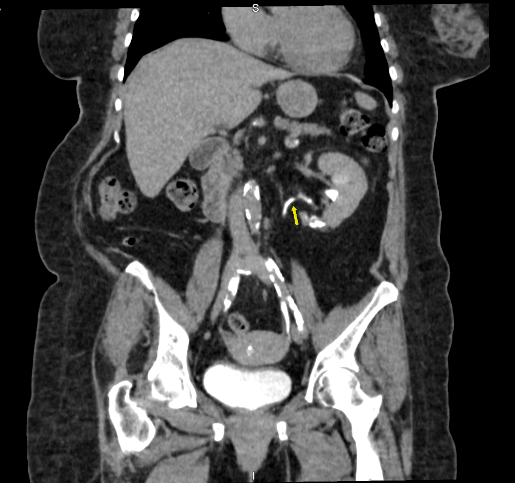 Imagem de uma Urotomografia
