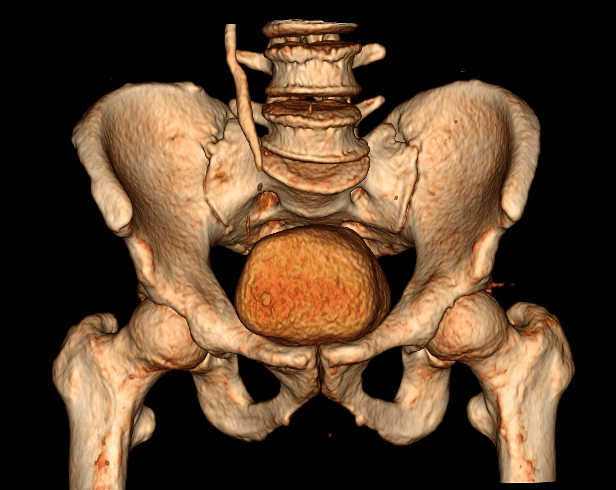 Imagem de uma Urotomografia