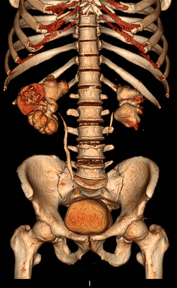 Imagem de uma Urotomografia
