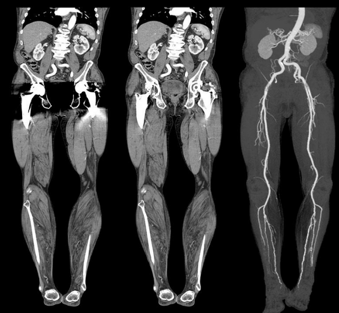 Imagem de um exame de Angiotomografia